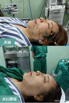 什么|过来人经验分享，给想做拉皮手术的人几句忠告