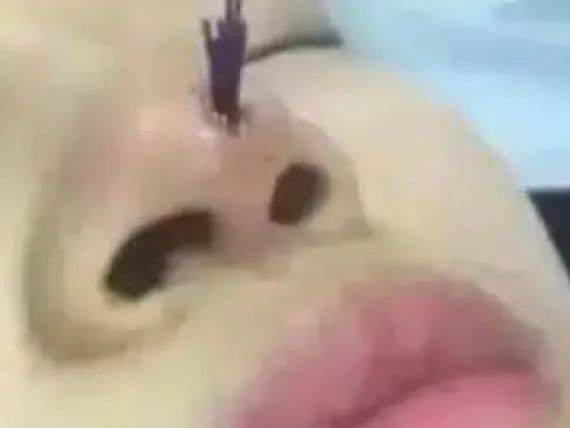 张力|五官C位可不能随便动,鼻综合也不是人人适合!