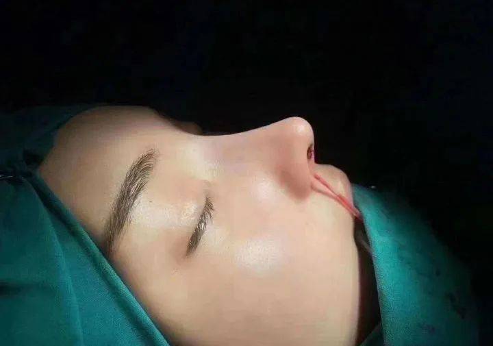 张力|五官C位可不能随便动,鼻综合也不是人人适合!