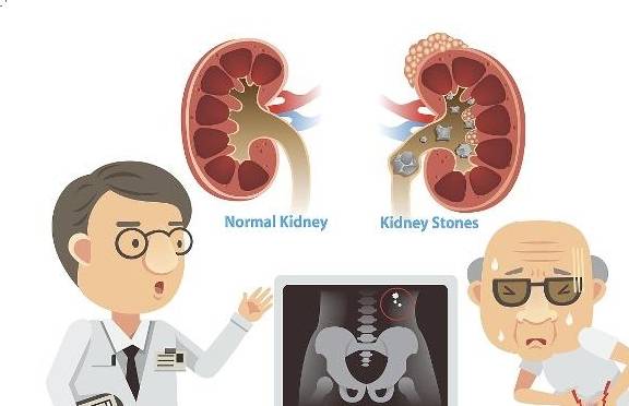 治疗|IgA肾病你了解多少？能彻底治愈吗？提醒：转阴并不是最佳疗效！