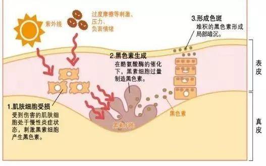 治疗|脸上化妆都遮不住的斑？我帮你解决