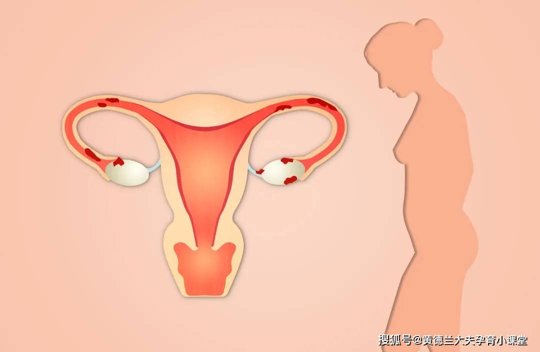 女人怎么会得盆腔炎 e40ccc2f58074c6890c8f7880ed582d9.jpeg