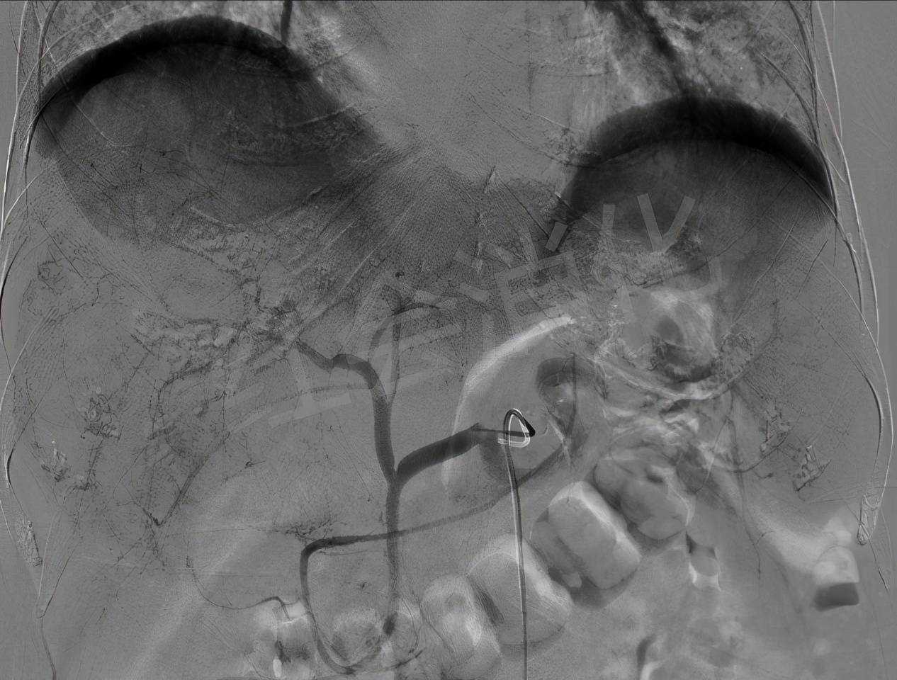 血管|西安市红会医院 让肿瘤“饿”死的TACE术 为两例中晚期肝癌排忧
