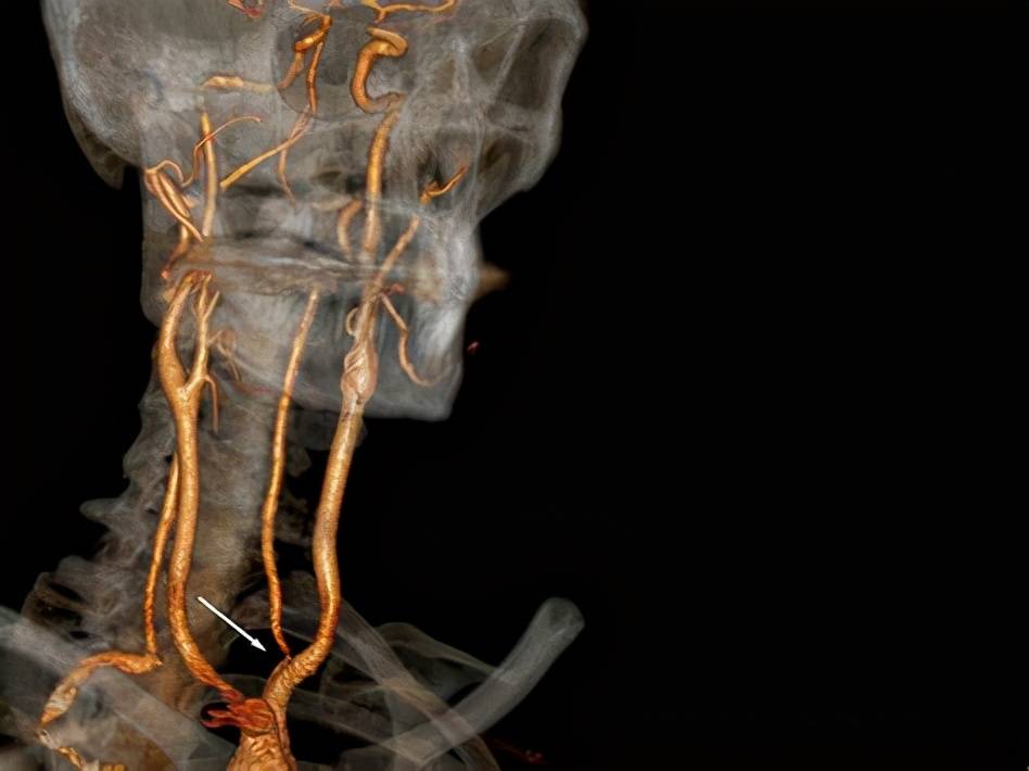 大脑|辟谣丨“腔隙性脑梗死”是什么病？该不该通血管？很多人都想错了