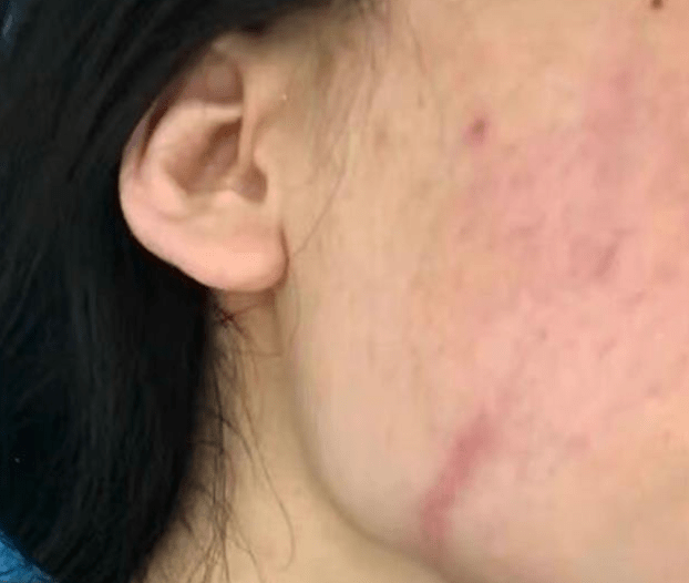 女子隆胸失败 维权被成都美绽美整形医院打到脑震荡(图2) 女子隆胸失败 维权被成都美绽美整形医院打到脑震荡(图2)