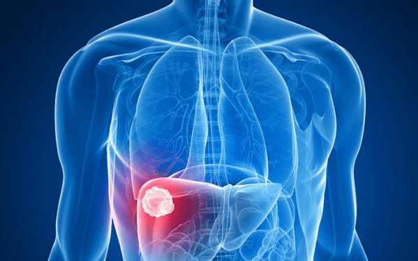 肝脏|肝不好，病难消！身体这部位出现“3黄”，或是肝脏发出求救信号