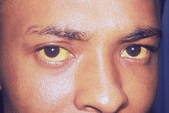 肝脏|肝不好，病难消！身体这部位出现“3黄”，或是肝脏发出求救信号