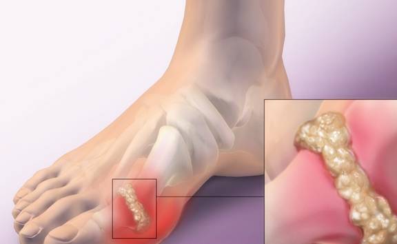 进行|痛风患者经常吃苏打片对肾脏真的有害吗?今天我们来告诉各位答案