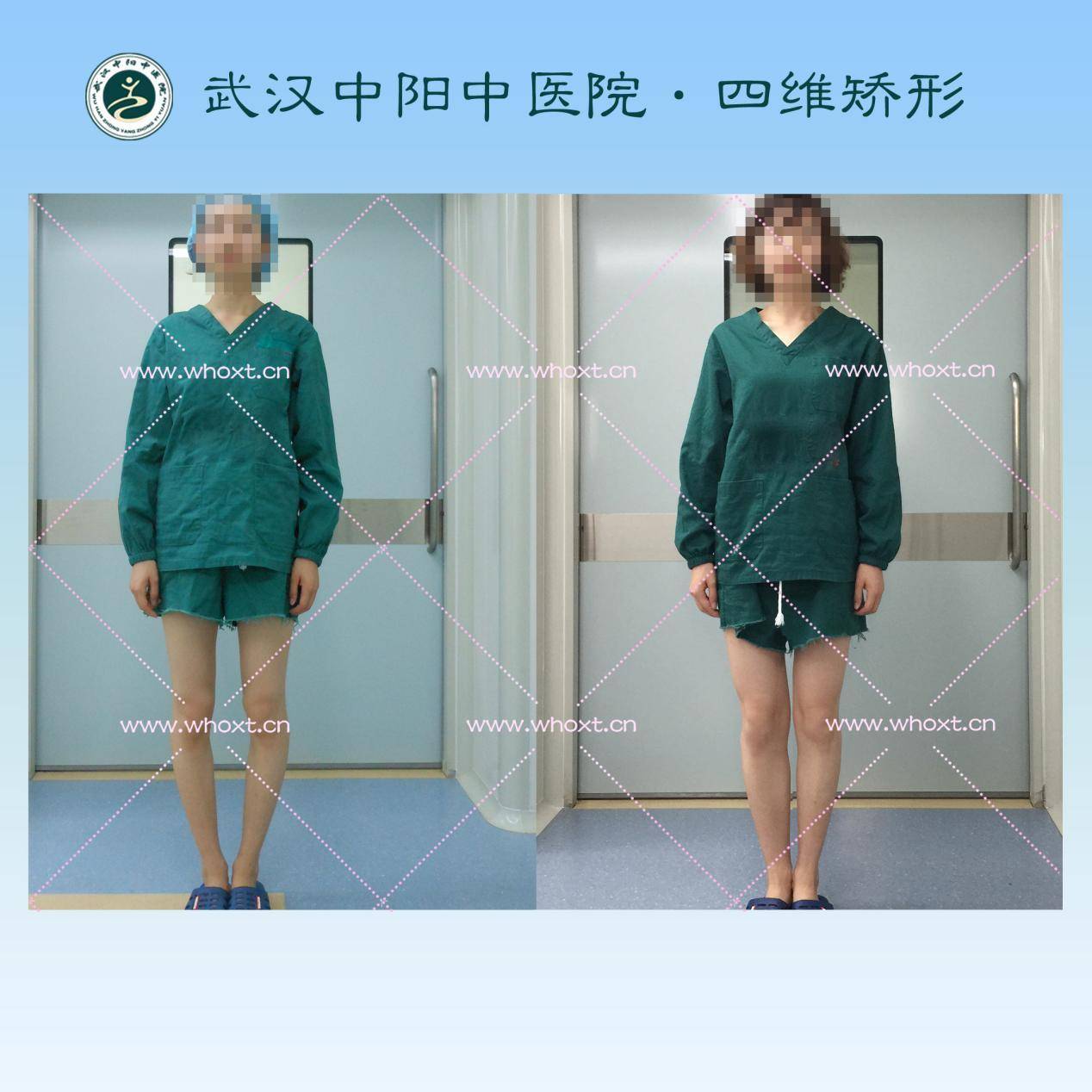 o型腿怎么形成的图解 45af87ee2e3e4d38828a7c5bed01ca46.jpeg