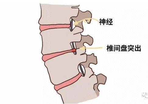 在外力因素的作用下,髓核组织突出或脱出于后方或椎管内,导致相邻脊