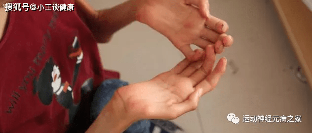 症状|渐冻人最新治疗进展！