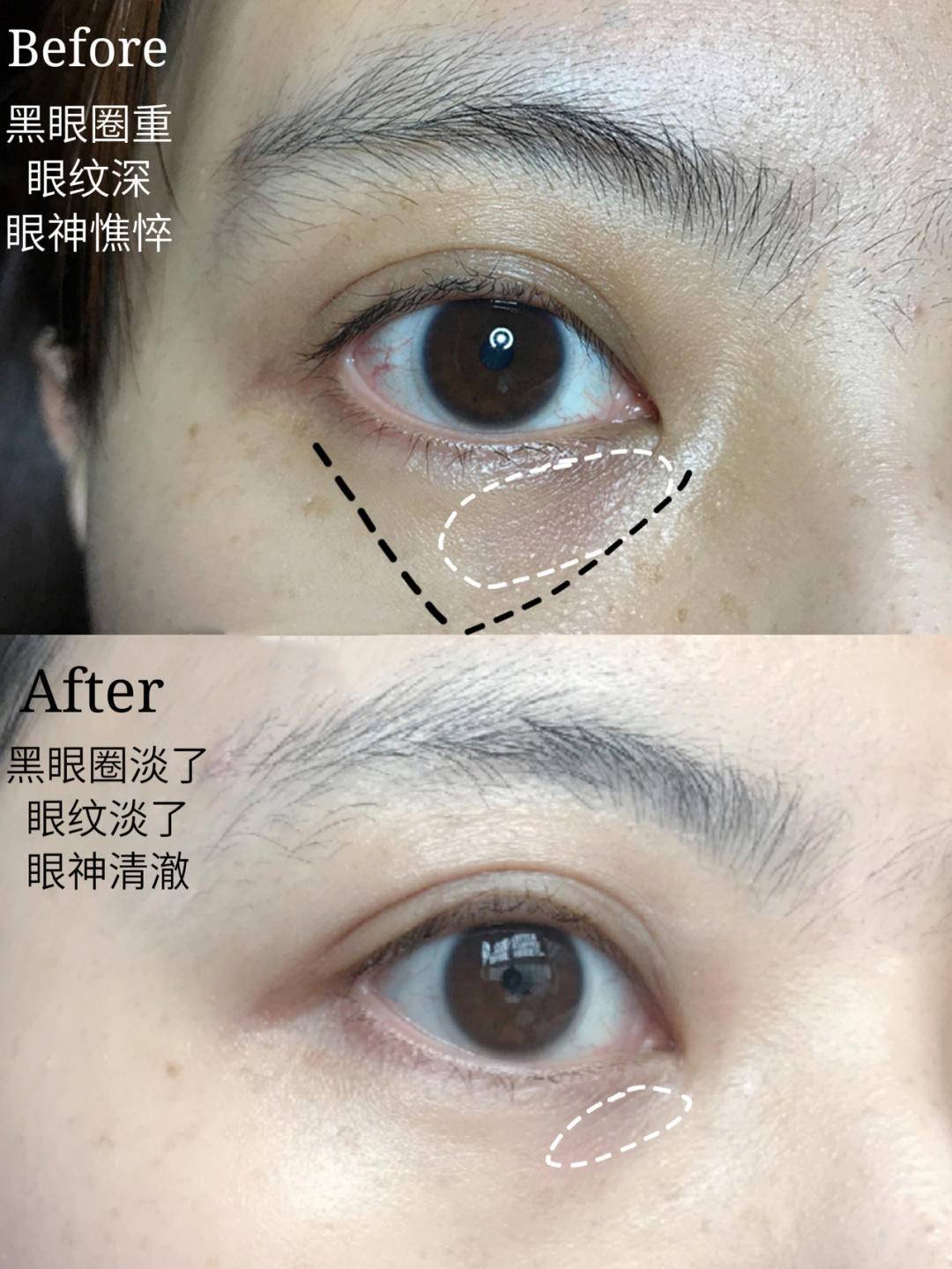眼睛|眼膜真的有用吗？眼睛上的细纹有救了！