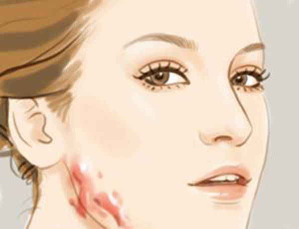 疤痕修复的六大精油有哪些技巧有哪些