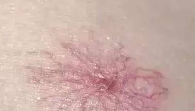 治疗|一喝酒就容易出现4种状况,请你立刻停止饮酒,肝脏可能有问题了