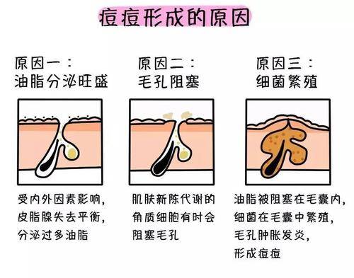 孕激素|新依美护肤：痘痘一波未平一波又起？如何改善痘痘肌？