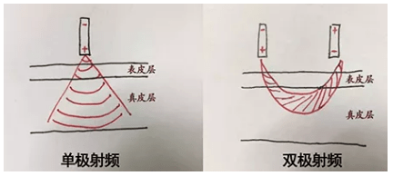 能量|热玛吉抗衰天花板，为何无法超越？