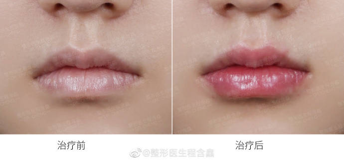 下唇你的唇形符合美学标准么 杭市一程含皛医生谈丰唇术
