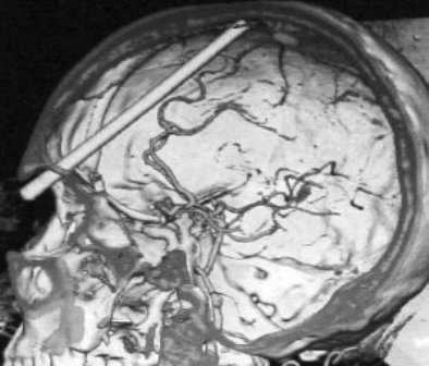 筷子|危险！谨防儿童误吸误食
