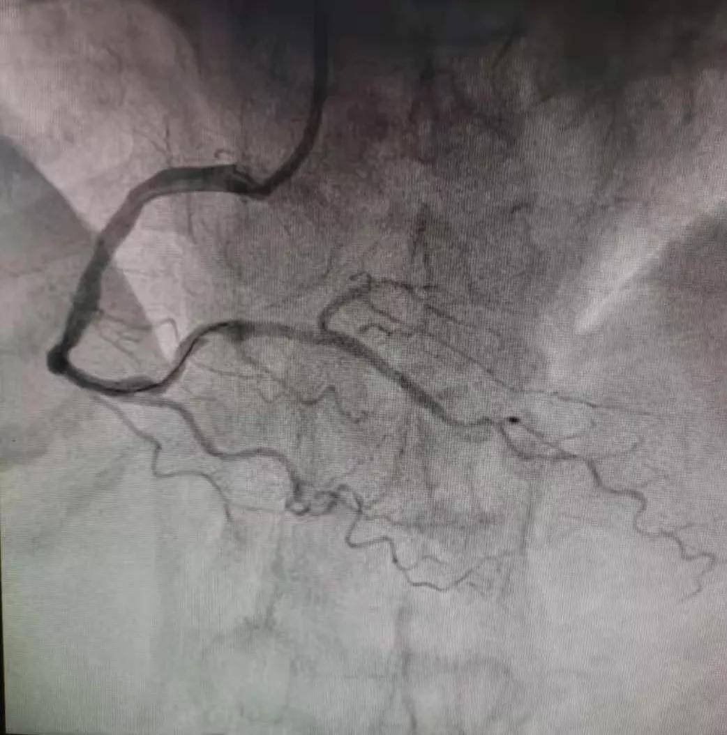 心肌|心梗救治，分秒必争 —— 我院心内科成功救治一位急性心梗患者