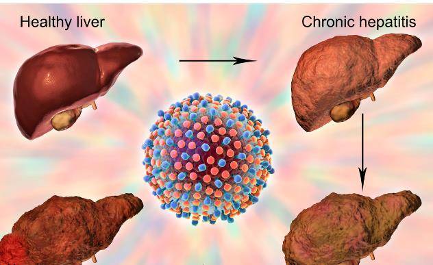 治疗|李兰娟院士：逆转乙肝肝硬化最好的药物就是抗病毒治疗