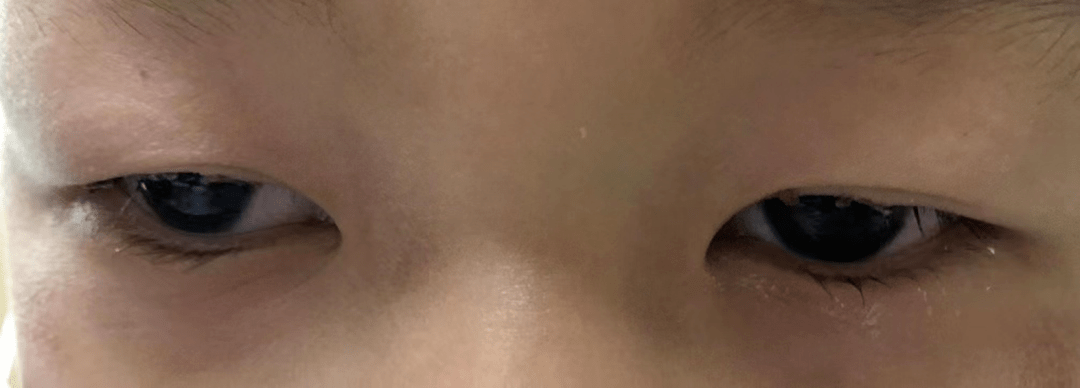 家长|眼睛奇痒，10岁女孩拔光睫毛，元凶竟是它