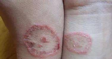 控制|皮肤是血糖的“晴雨表”，皮肤有4种表现，就是让你控糖的信号