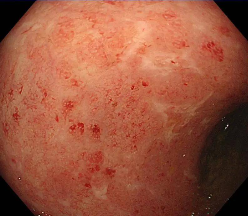 溃疡性结肠炎活不过10年!