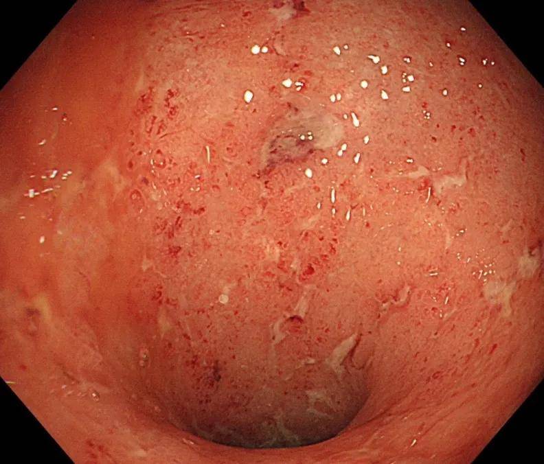 溃疡性结肠炎活不过10年!