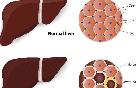 严重|频繁有这5个感受，可能你的肝脏被“为难”了