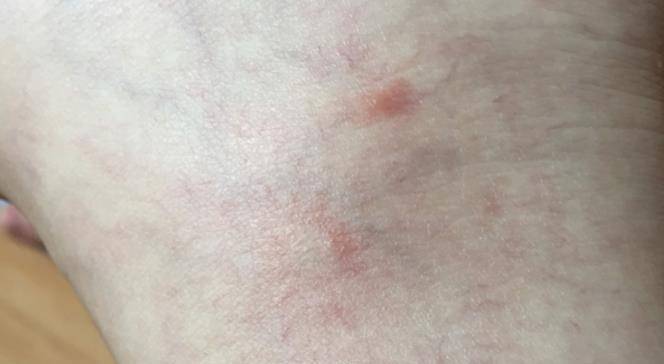 因为|肝脏不好皮肤先知,专家提醒:皮肤出现以下症状,肝或已稀烂