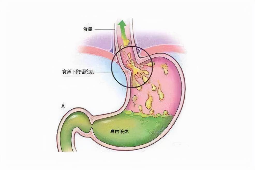 胆汁反流性胃炎有些症状