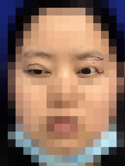 双眼皮|西安国际医学整形医院王爱武修复眼球外露六年眼睑缺损患者