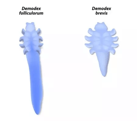 皮肤|曝光了!皮肤CT看到的痘痘竟然是这种画风!