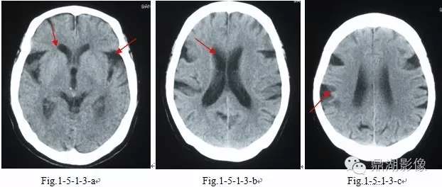 ②腦溝寬度>5mm可提示腦萎縮;③側腦室額角,枕角,顳角變圓鈍,則提示