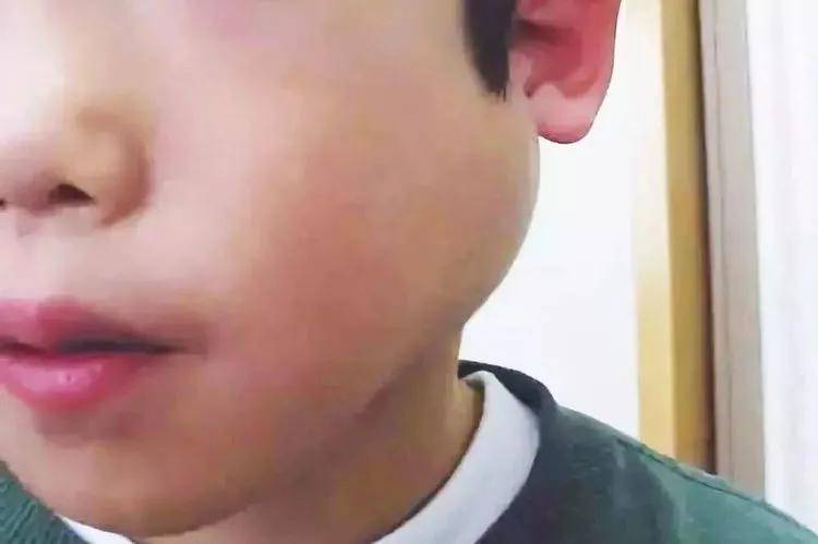 病毒|10月初这支自费疫苗必须带孩子打！预防秋冬季传染病就靠它