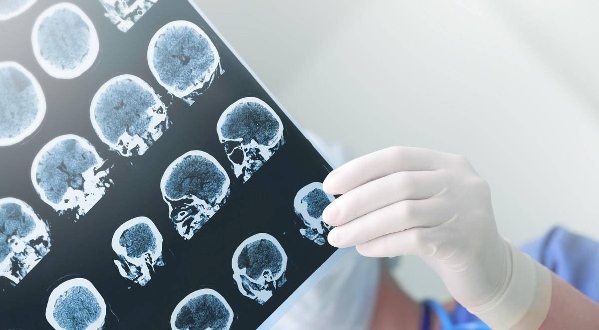 生活|“中风”应该如何预防？记好脑卒中的“两道防线”