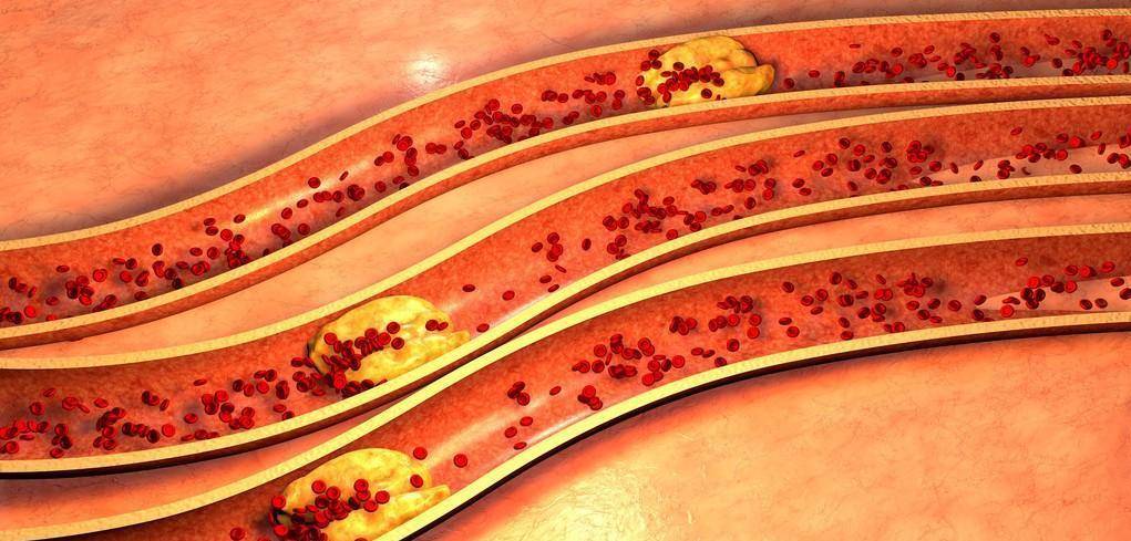 生活|“我才35岁就要做支架?”你虽然年轻,但是血管已经70岁了