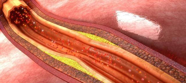 他汀|我对那个动脉有斑块的人说,最好不要停用他汀,原因是什么?