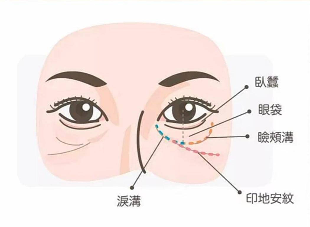 颧骨皱纹也许会迟到，但永远不会缺席