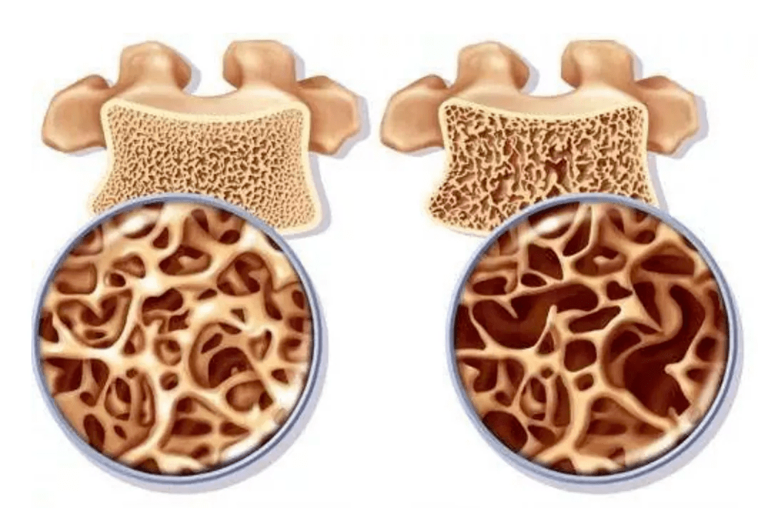 筛查|世界骨质疏松日｜市三院内分泌科联合神经脊柱外科、康复科举行大型义诊活动