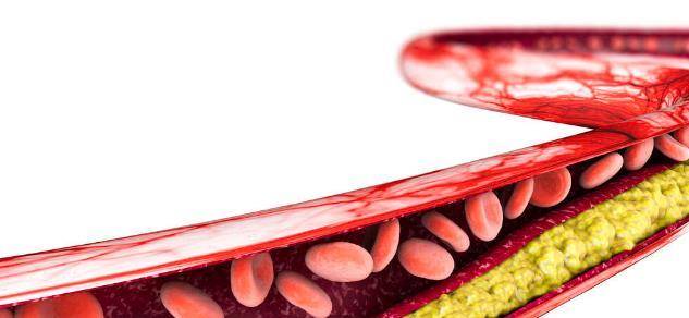 他汀|降脂新药依折麦布，疗效明确不伤肝，他汀好搭档，6类人特别适用