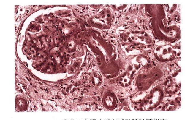 肾脏|从高血压到尿毒症，高血压“三不”现象，但高血压时刻重视你