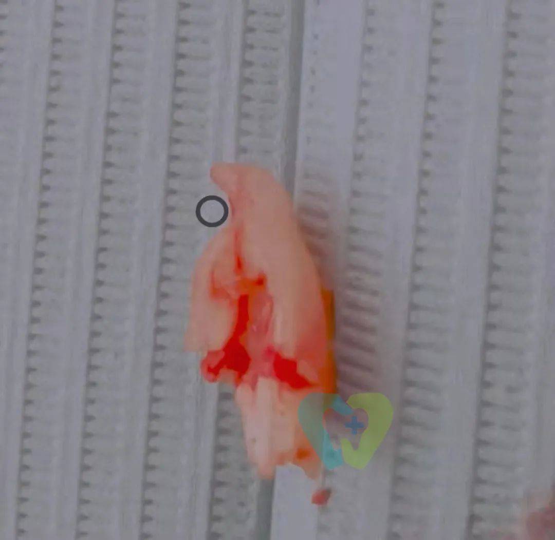 妙手|智齿牙根弯曲紧贴神经管，医生妙手微创拔除