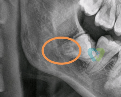 妙手|智齿牙根弯曲紧贴神经管，医生妙手微创拔除