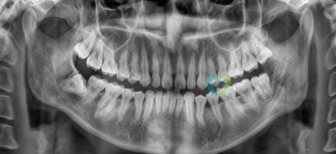 妙手|智齿牙根弯曲紧贴神经管，医生妙手微创拔除