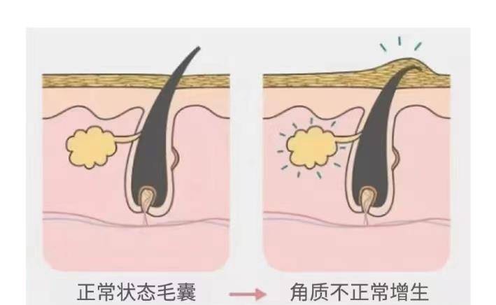 汗孔关于皮肤的基础知识