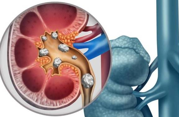 食品|“惹上”肾结石，多半是这3件事做多了，且男性占比要高于女性