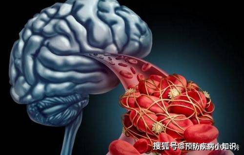 饮食|为什么在中国，脑梗患者越来越多？医生：与肥肉无关，望你了解