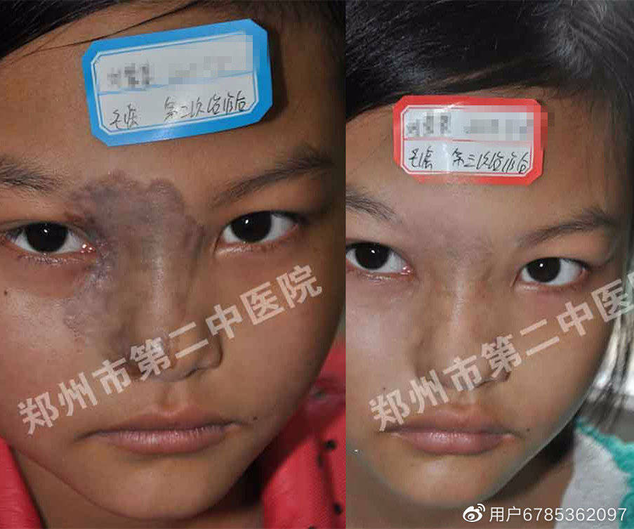 郑州市第二中医院:黑色胎记的症状及其治疗