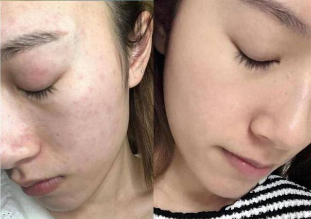 症状假如脸上这3个症状明显，那你面部可能有“螨虫”，需要尽早改善